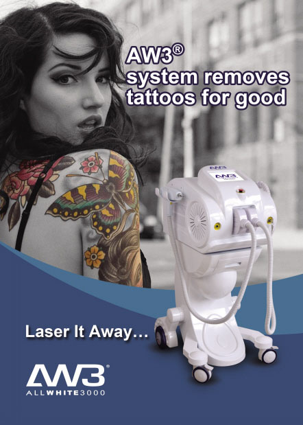 Laser Removal
